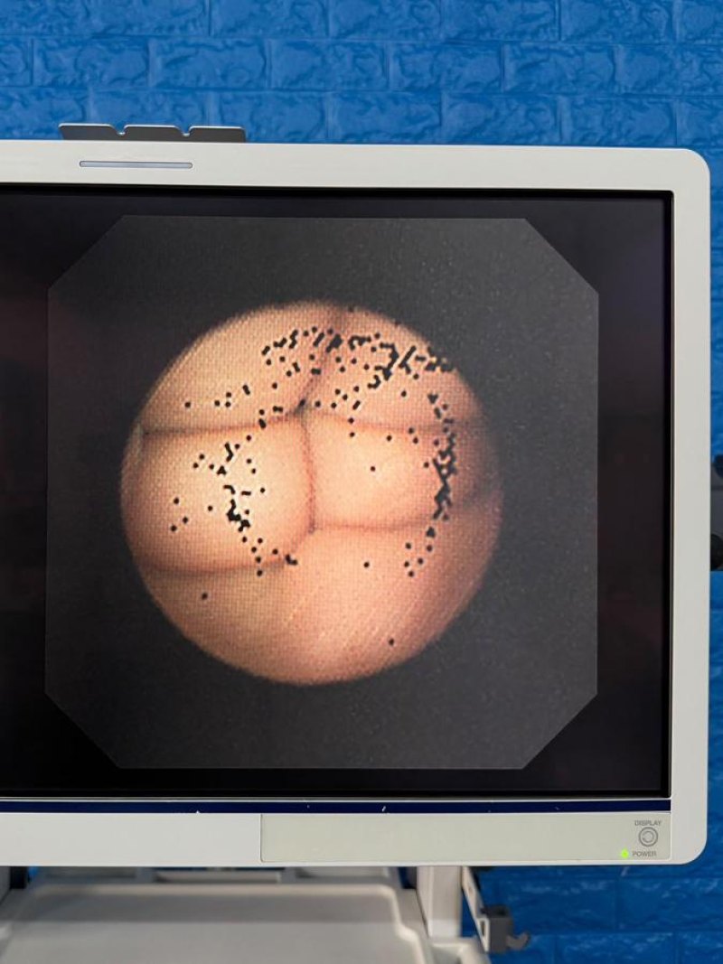 Olympus BF-UC260FW Linear Ultrasound Bronchoscope EBUS