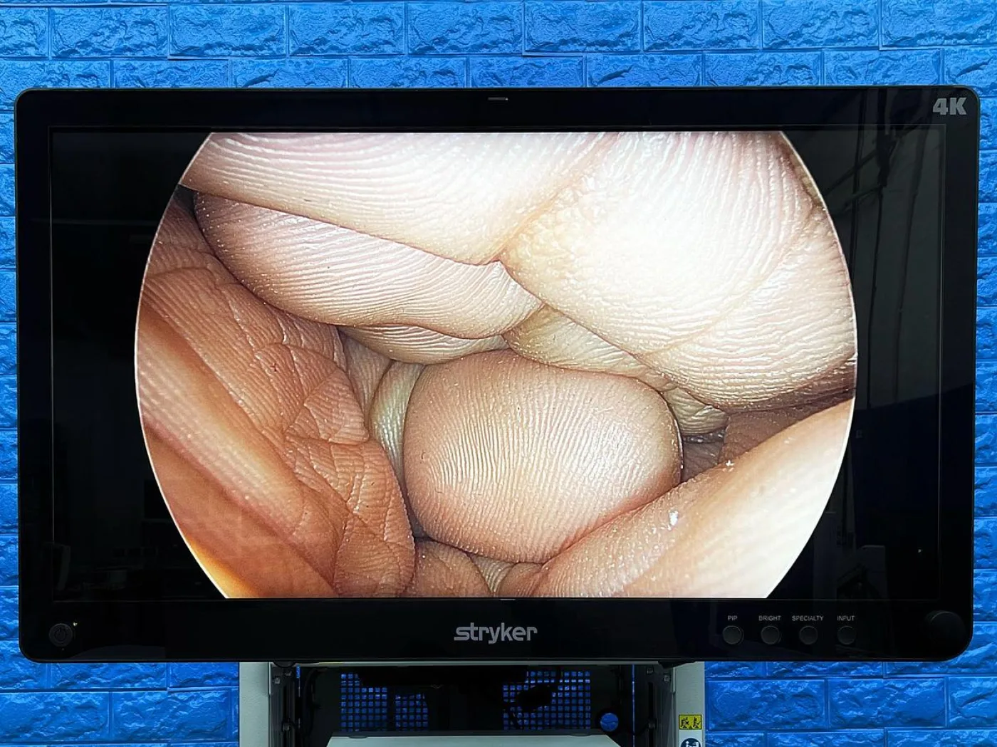 Stryker 1688 4K Arthoscopy Laparoscopy Complete Tower Including -Lcd Monitor 4k 32” YOM: 2021 -Pneumo Clear -1688 Camera Head -SDC3 HD Information Management YOM: 2012 -1688 4K Image Processor YOM: 2020 -LII LED Light Source YOM: 2020 - 8