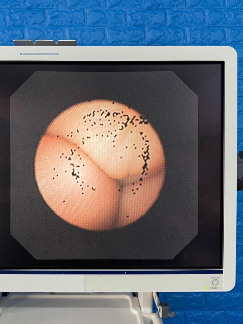 Olympus BF-UC260FW Linear Ultrasound Bronchoscope EBUS