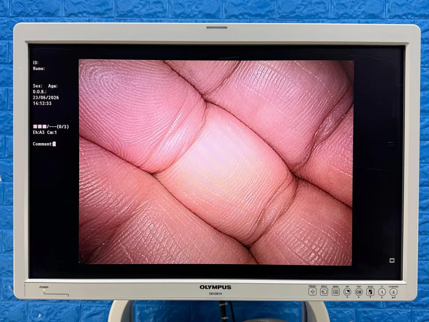 Olympus WA50010A EndoEye II HD Video Laparoscope 10mm 0 Degree REF: WA50010A - 2